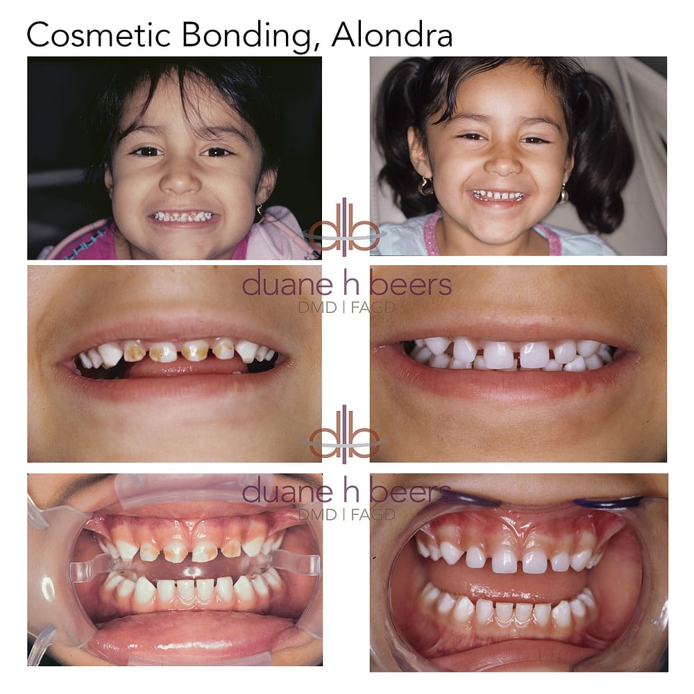 cosmetic-bonding-alondra