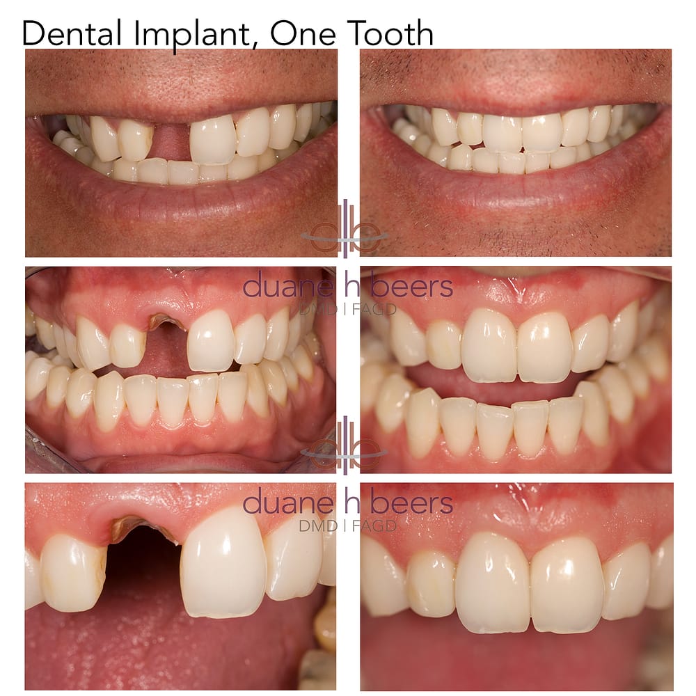 Dental Implant, Single Tooth
