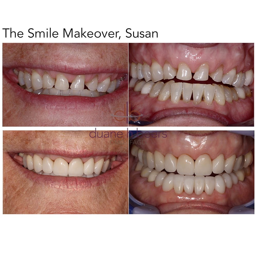 Smile Makeover, Susan
