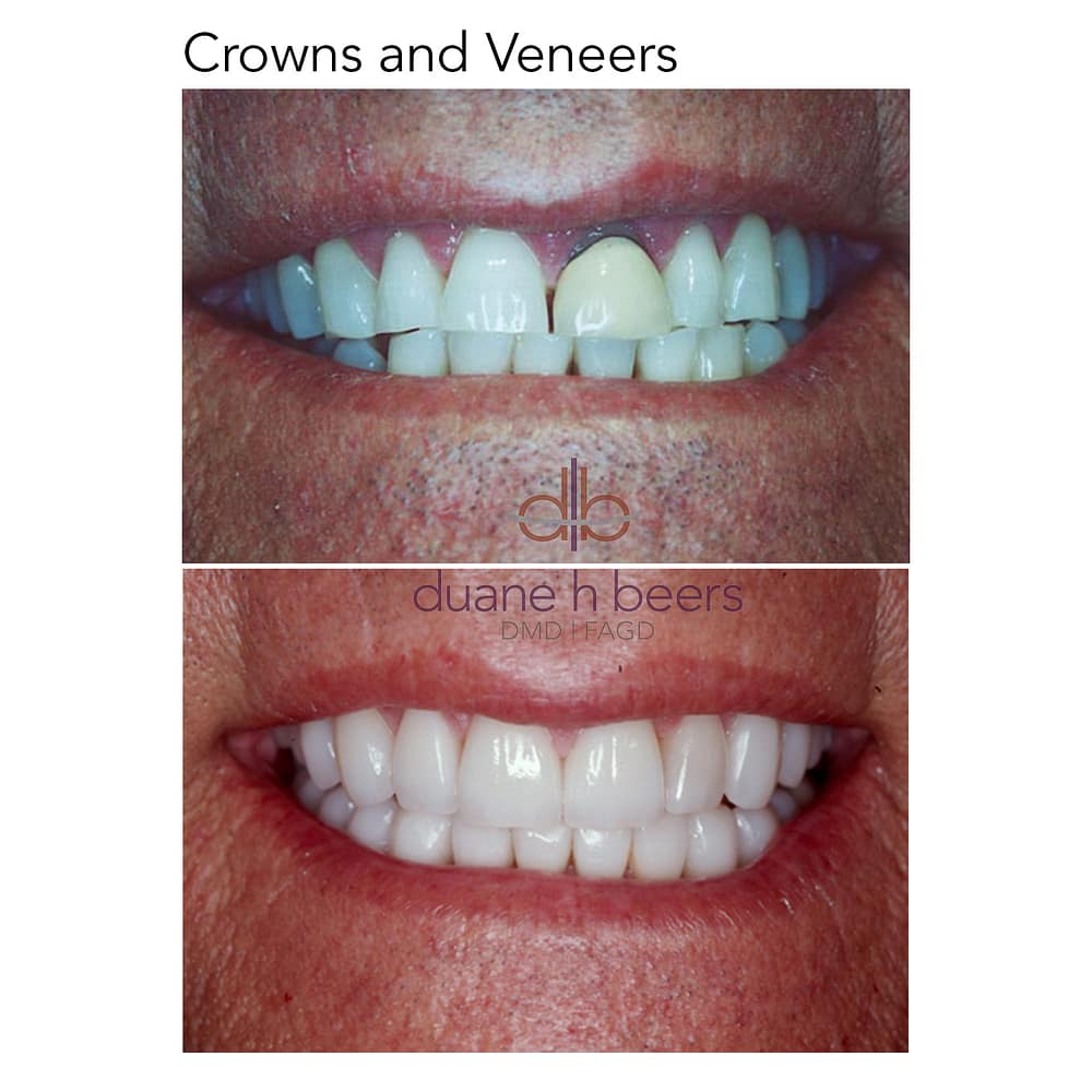 Crowns and Veneers