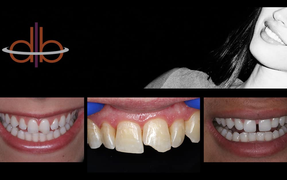Cosmetic Bonding
