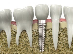 Dental Implant in Socorro, New Mexico